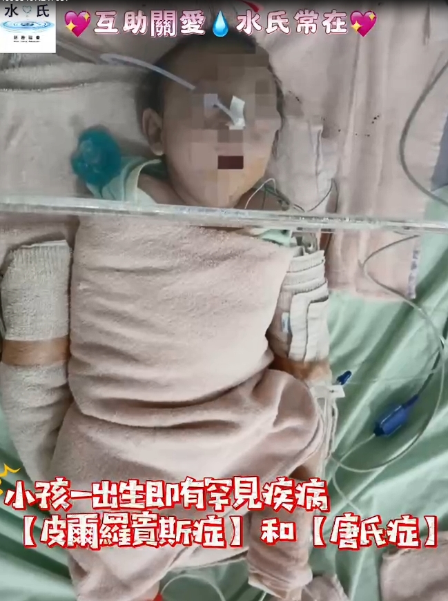 罕病【皮爾羅賓斯症】+【唐氏症】寶寶