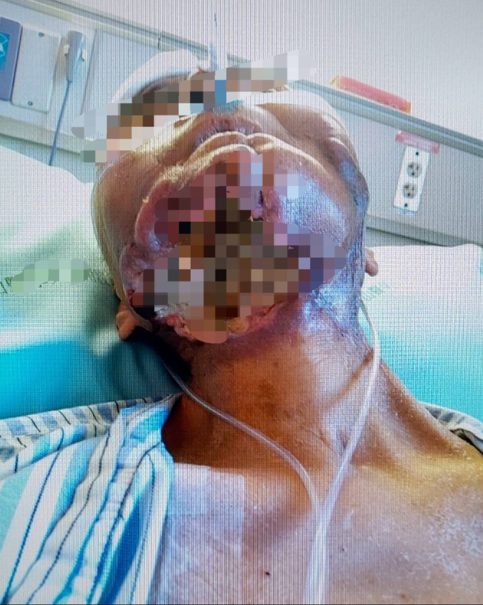 口腔癌末人生的最後倒數